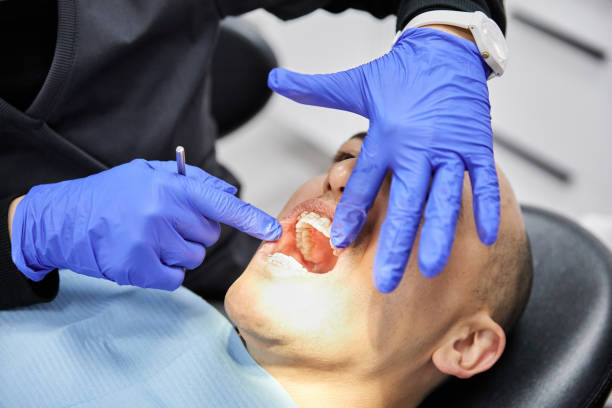 Best Knocked-Out Tooth (Avulsed Tooth) Treatment in Century, FL